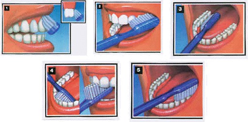 Brossage - Parodontologie